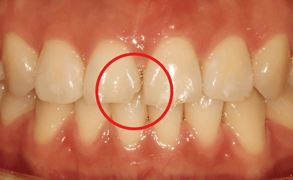 넘어져서 부러진 앞니, 심미 레진으로 감쪽같이 복원한 치료 사례 - 이미지 3