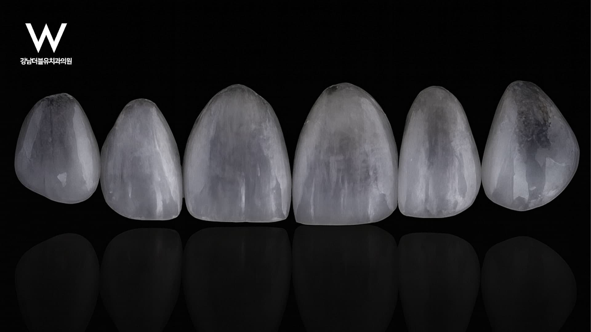 무삭제 라미네이트, 기존 라미네이트와 뭐가 다를까?