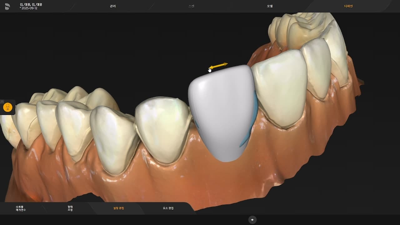 무삭제 라미네이트가 더 잘 붙는 이유 - 이미지 6