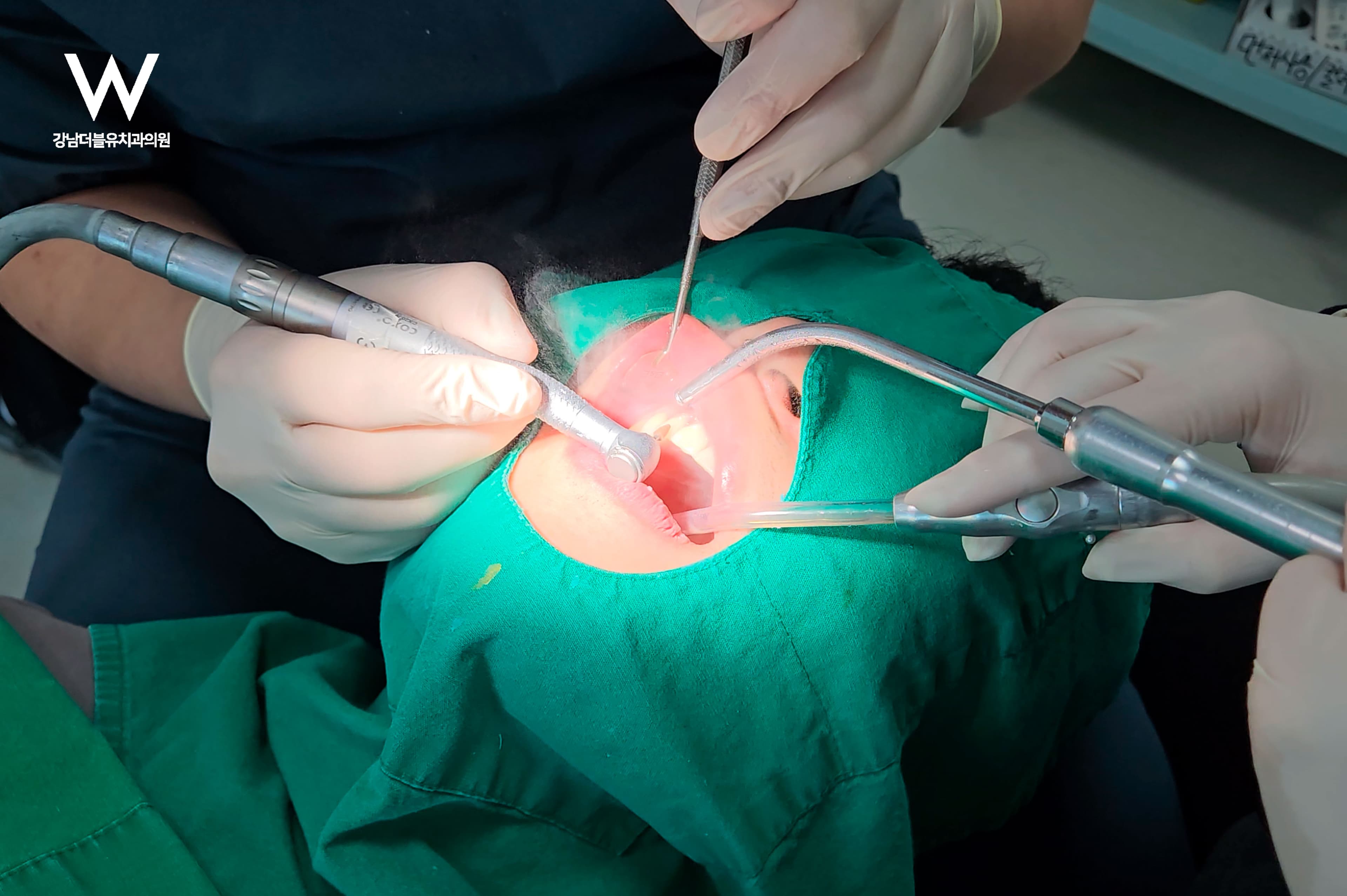 라미네이트 시술, 꼭 알아야 할 진실과 조언