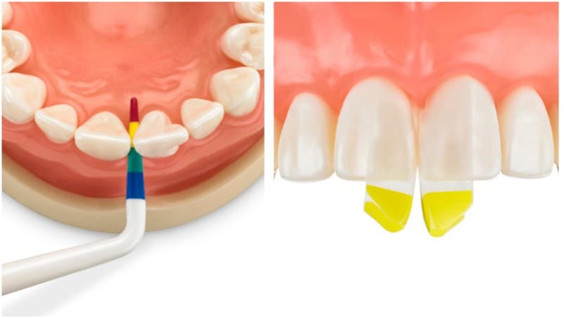교정 후 생긴 블랙트라이앵글, 바이오클리어로 자연스럽게 해결 - 이미지 4