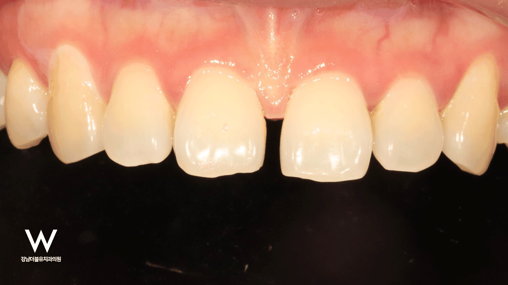 앞니 벌어짐, 한시간만에 해결! 바이오클리어 치료 케이스 - 이미지 2