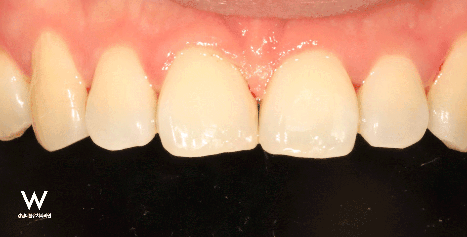 앞니 벌어짐, 한시간만에 해결! 바이오클리어 치료 케이스 - 이미지 5