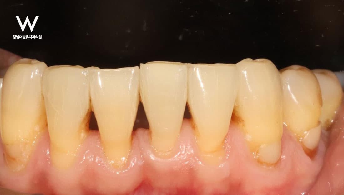 치간 칫솔 쓰면 블랙 트라이앵글이 커질까요? - 이미지 2