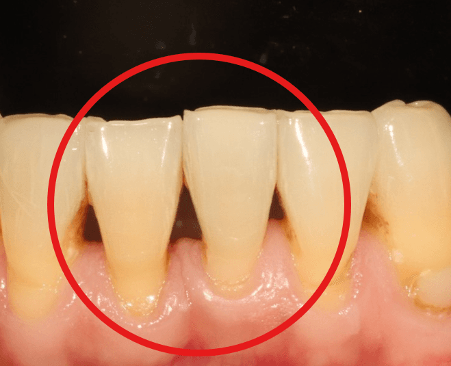 교정 후 블랙 트라이앵글, 잇몸 필러로 해결할 수 있을까? - 이미지 2