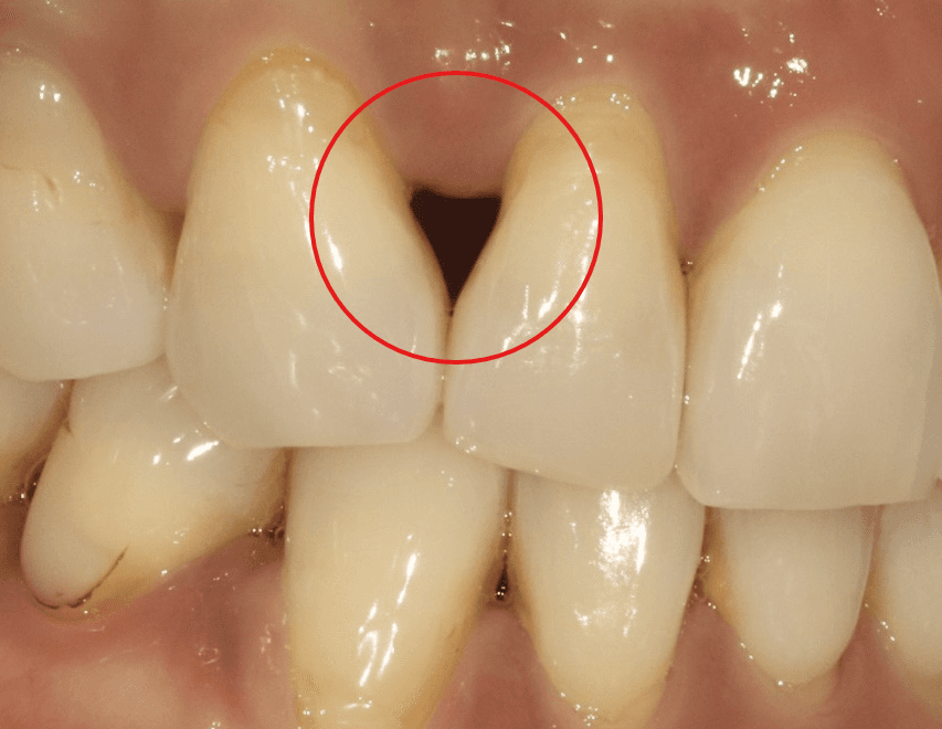 교정 후 블랙 트라이앵글, 잇몸 필러로 해결할 수 있을까? - 이미지 4