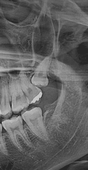 사랑니 발치, 얼마나 걸릴까? 시간과 비용의 모든 것 - 이미지 3