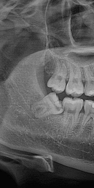 사랑니 4개, 하루에 다 뽑아도 될까요? - 이미지 2