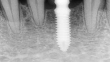 Case 4 After