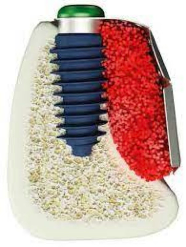 3D Bone Graft with Titanium Mesh