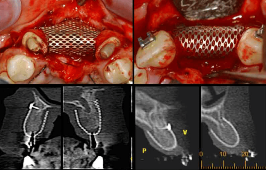 Titanium Mesh Clinical
