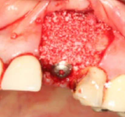 Bone Graft Real Case