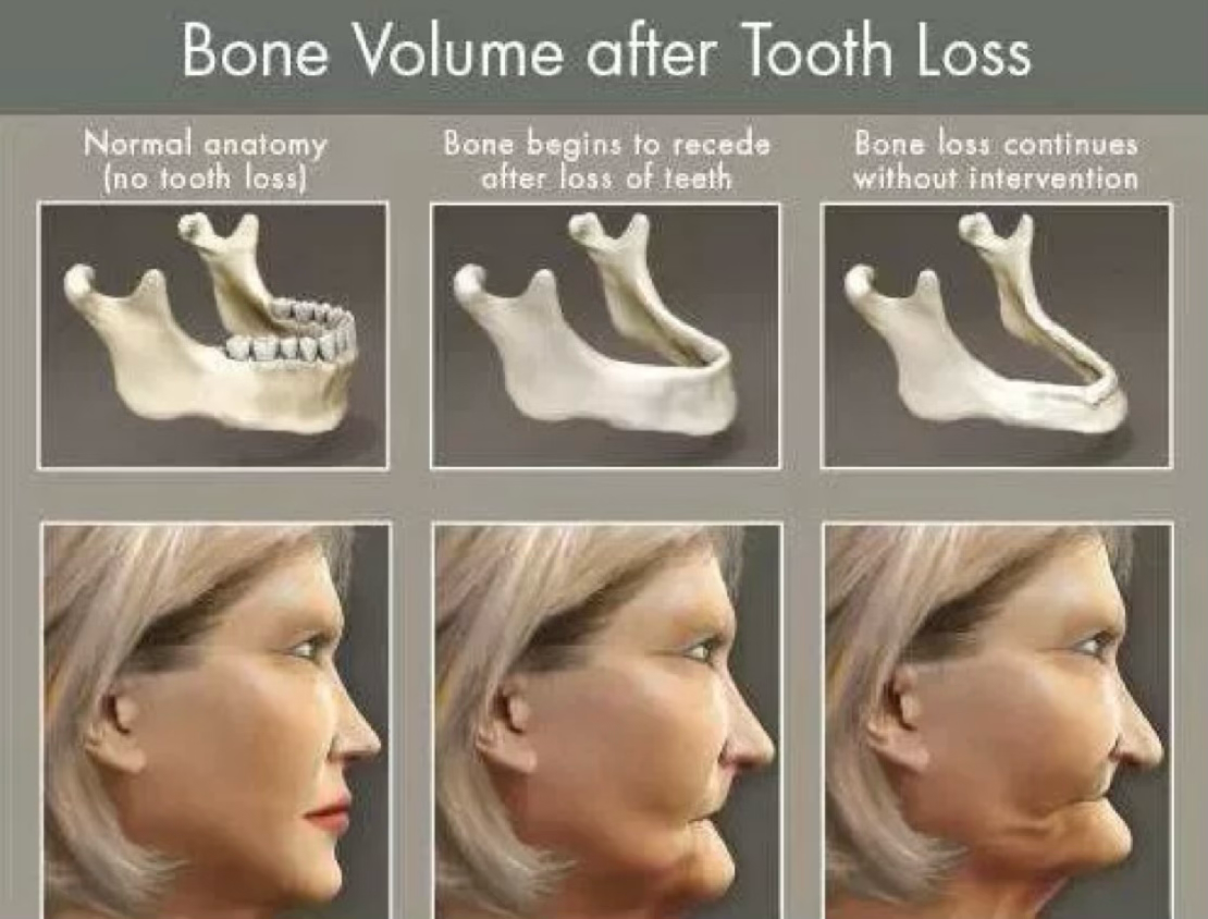 Bone Volume after Tooth Loss
