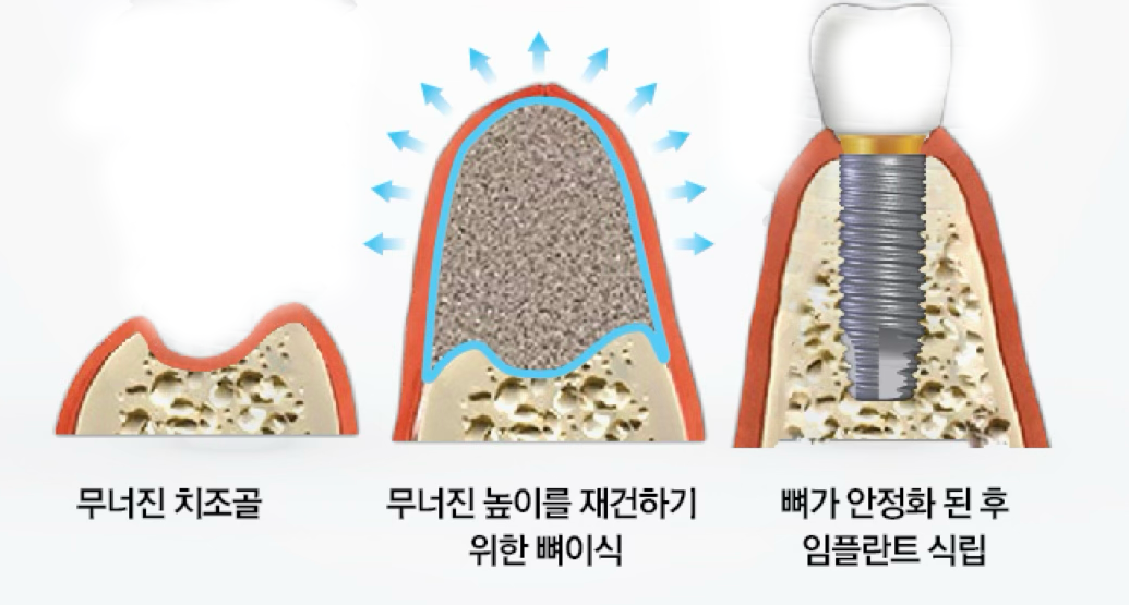 Horizontal and Vertical Bone Augmentation