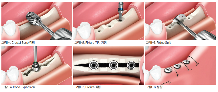 Ridge Splitting Surgery