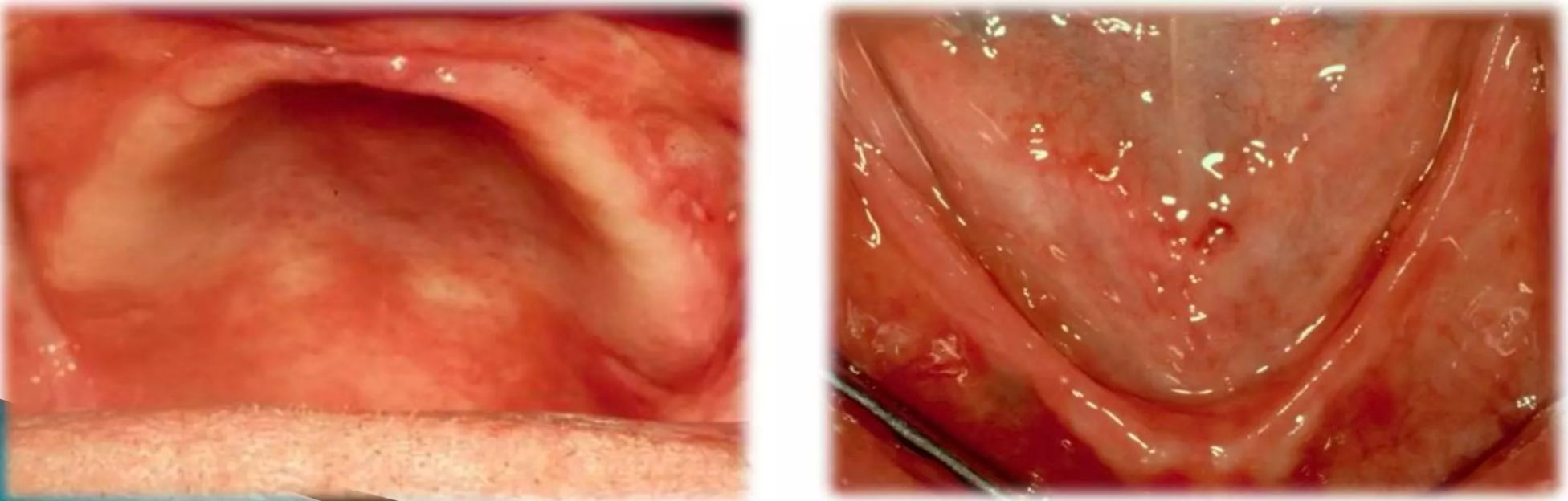 Thin Bone after Tooth Loss