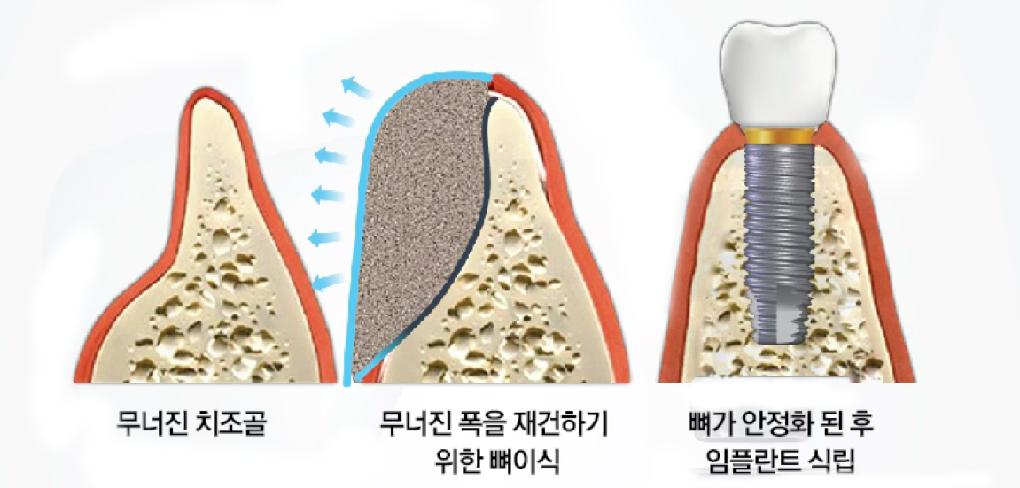 Horizontal Bone Augmentation