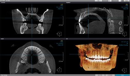 3D CT 진단