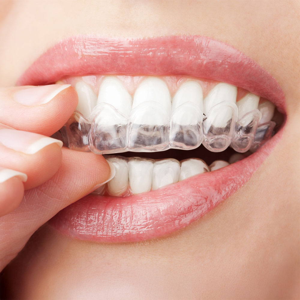 Clear Aligners