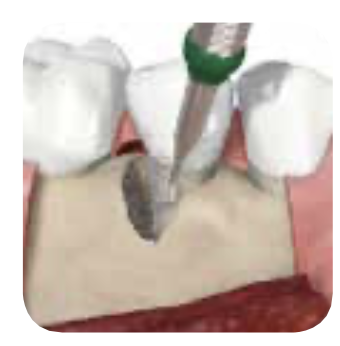 STEP 3: Root Planning