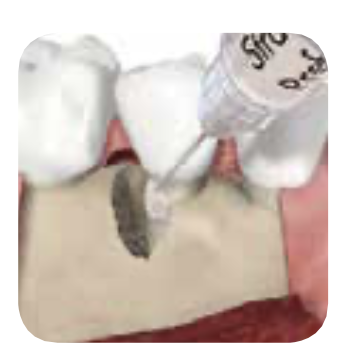 STEP 4: 치근에 도포