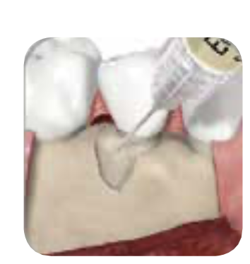 STEP 5: 포켓에 도포