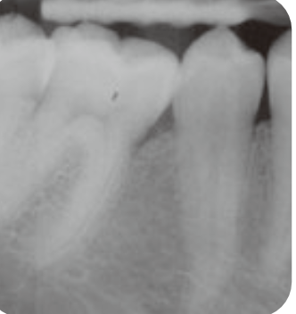 엠도게인 치료 후 X-ray