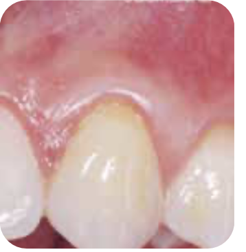 엠도게인 치료 후 잇몸 상태