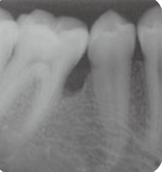 엠도게인 치료 전 X-ray