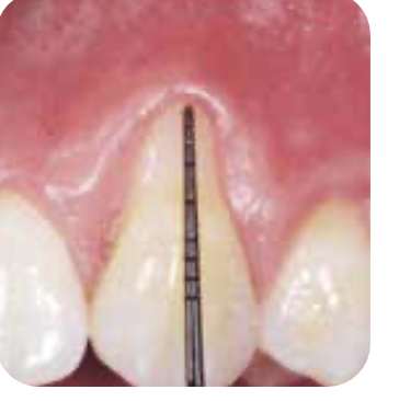 엠도게인 치료 전 잇몸 상태