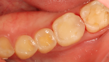 After treatment