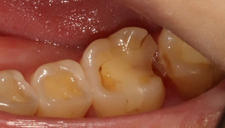 Before treatment